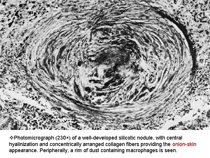 v. Photomicrograph (230×) of a well-developed silicotic nodule, with central hyalinization and concentrically arranged
