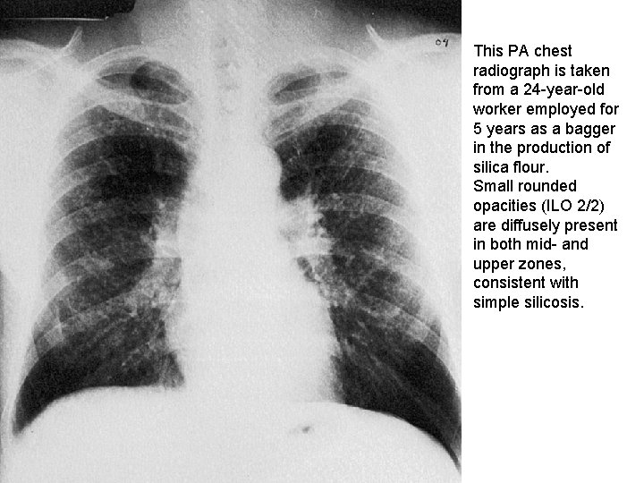 This PA chest radiograph is taken from a 24 -year-old worker employed for 5