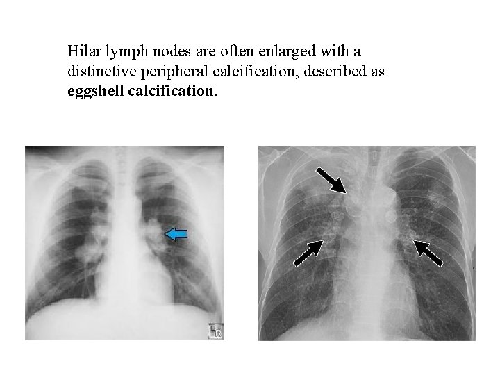 Hilar lymph nodes are often enlarged with a distinctive peripheral calcification, described as eggshell