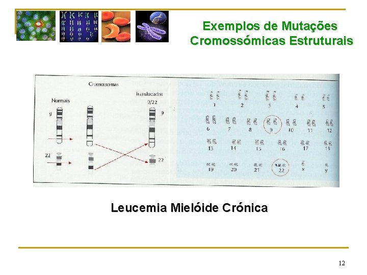 Exemplos de Mutações Cromossómicas Estruturais Leucemia Mielóide Crónica 12 