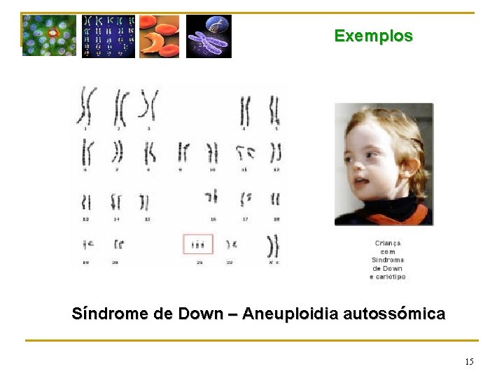 Exemplos Síndrome de Down – Aneuploidia autossómica 15 