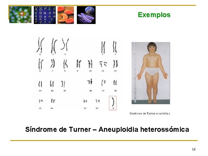 Exemplos Síndrome de Turner – Aneuploidia heterossómica 16 