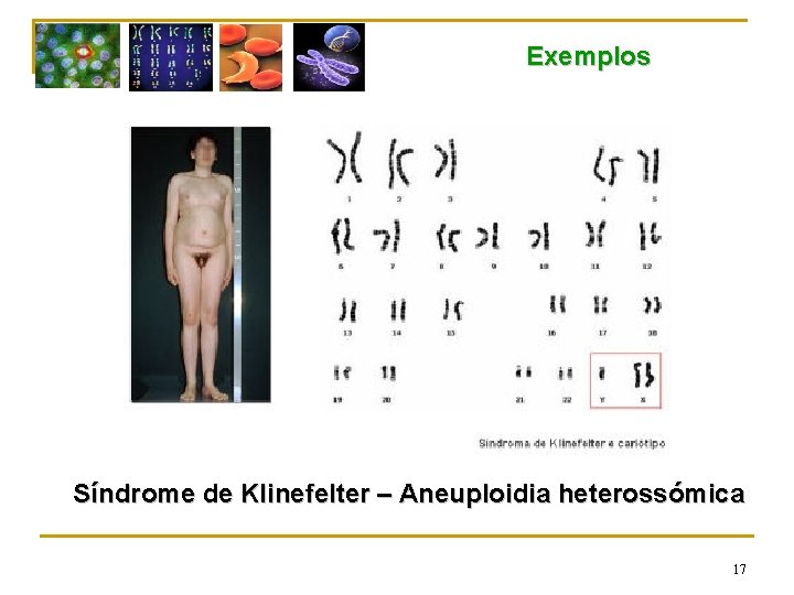 Exemplos Síndrome de Klinefelter – Aneuploidia heterossómica 17 