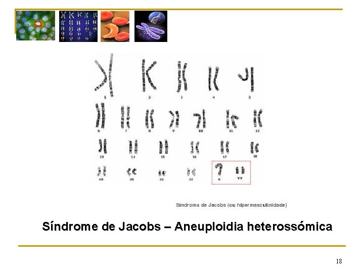 Síndrome de Jacobs – Aneuploidia heterossómica 18 