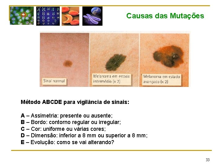 Causas das Mutações Método ABCDE para vigilância de sinais: A – Assimetria: presente ou