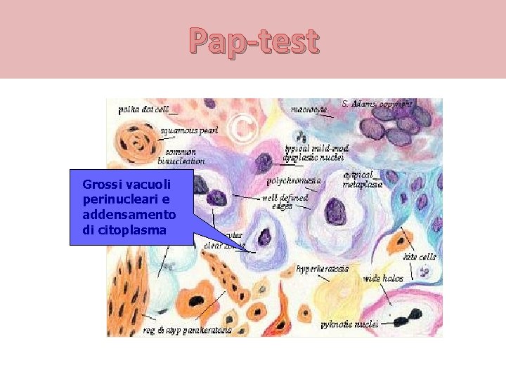 Pap-test Grossi vacuoli perinucleari e addensamento di citoplasma 