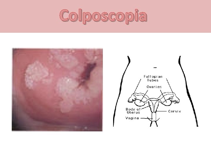 Colposcopia 