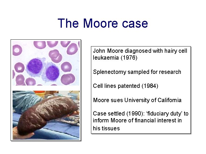 The Moore case John Moore diagnosed with hairy cell leukaemia (1976) Splenectomy sampled for