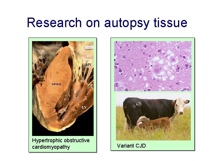 Research on autopsy tissue Hypertrophic obstructive cardiomyopathy Variant CJD 