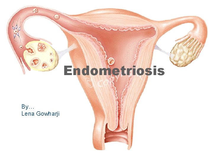 Endometriosis By… Lena Gowharji 
