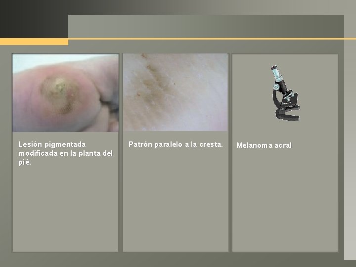 Lesión pigmentada modificada en la planta del pié. Patrón paralelo a la cresta. Melanoma