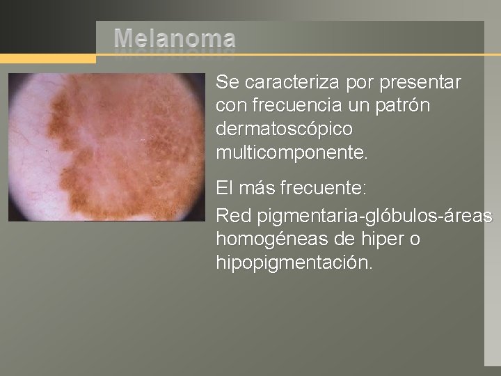 Se caracteriza por presentar con frecuencia un patrón dermatoscópico multicomponente. El más frecuente: Red