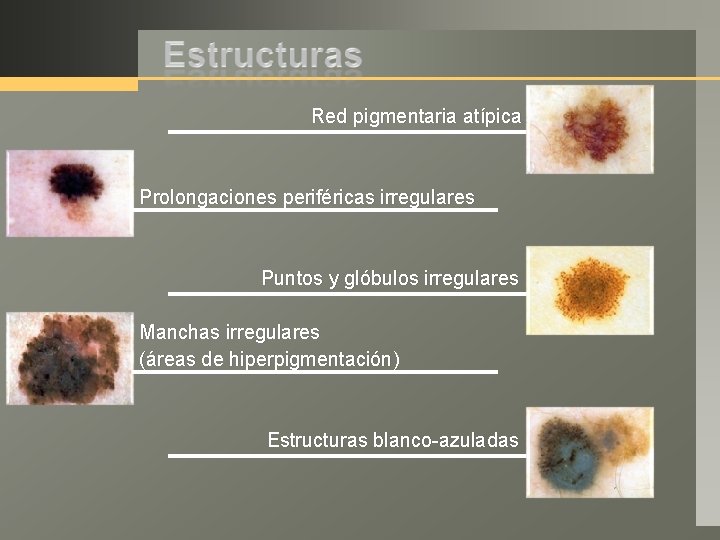 Red pigmentaria atípica Prolongaciones periféricas irregulares Puntos y glóbulos irregulares Manchas irregulares (áreas de