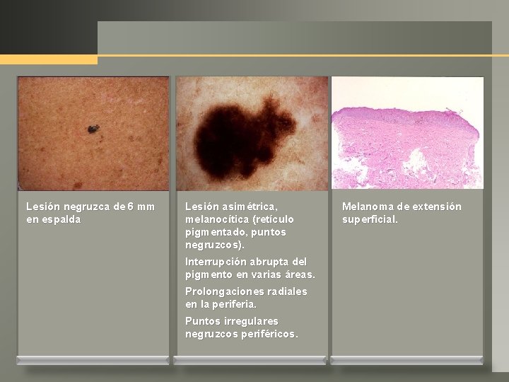 Lesión negruzca de 6 mm en espalda Lesión asimétrica, melanocítica (retículo pigmentado, puntos negruzcos).