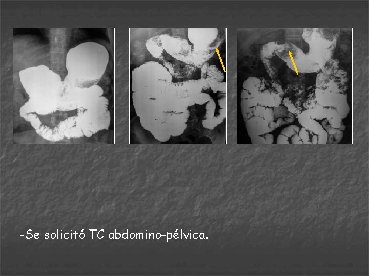 -Se solicitó TC abdomino-pélvica. 