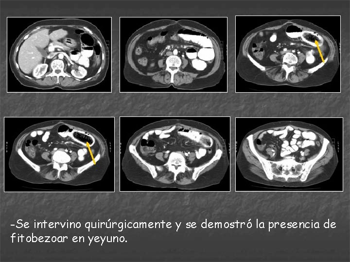 -Se intervino quirúrgicamente y se demostró la presencia de fitobezoar en yeyuno. 