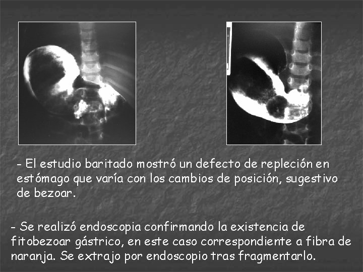 - El estudio baritado mostró un defecto de repleción en estómago que varía con