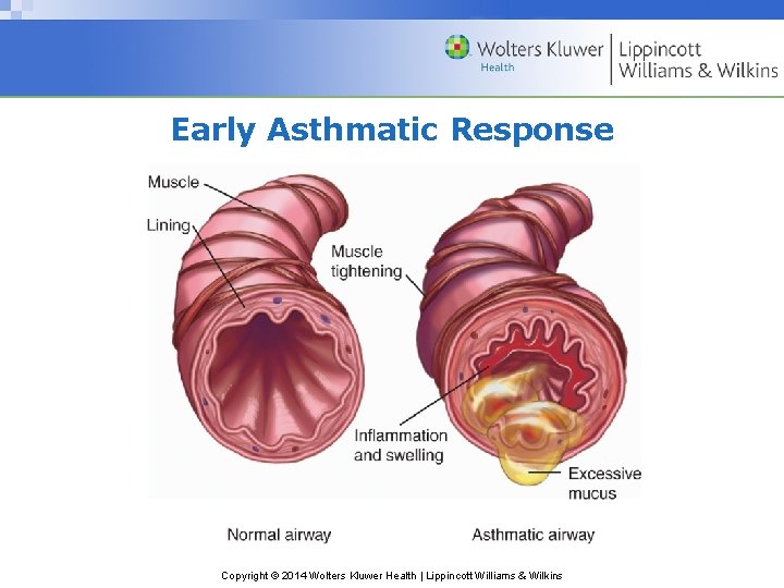 Early Asthmatic Response Copyright © 2014 Wolters Kluwer Health | Lippincott Williams & Wilkins