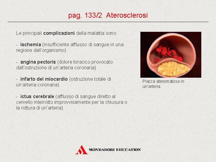 pag. 133/2 Aterosclerosi Le principali complicazioni della malattia sono: - ischemia (insufficiente afflusso di