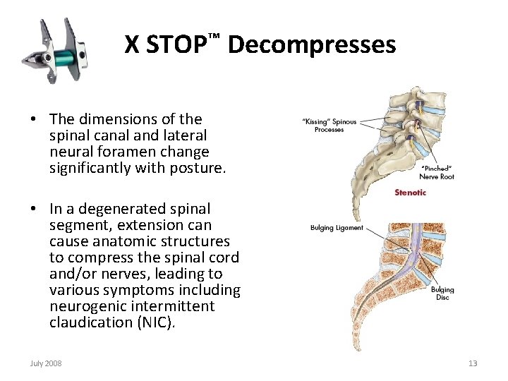  X STOP™ Decompresses • The dimensions of the spinal canal and lateral neural