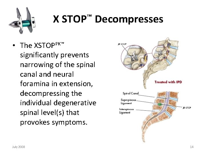  X STOP™ Decompresses • The XSTOPPK™ significantly prevents narrowing of the spinal canal
