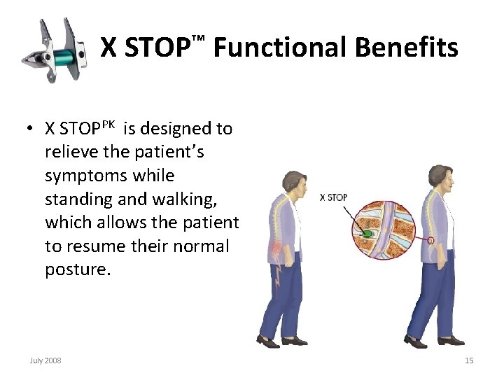  X STOP™ Functional Benefits • X STOPPK is designed to relieve the patient’s