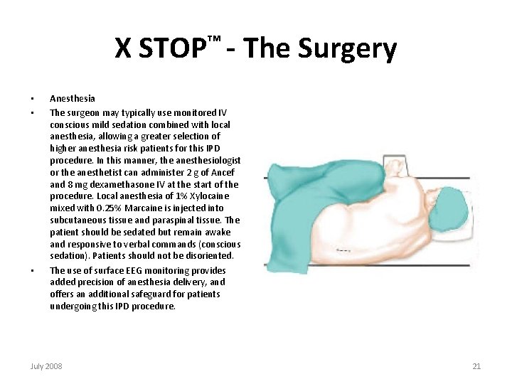 X STOP™ - The Surgery • • • Anesthesia The surgeon may typically use