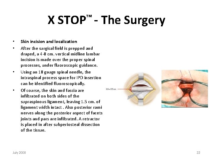 X STOP™ - The Surgery • • Skin incision and localization After the surgical