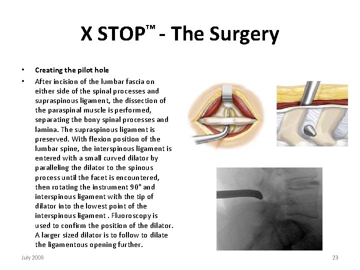 X STOP™ - The Surgery • • Creating the pilot hole After incision of