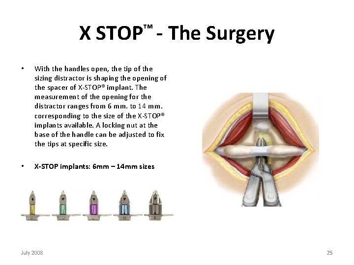 X STOP™ - The Surgery • With the handles open, the tip of the