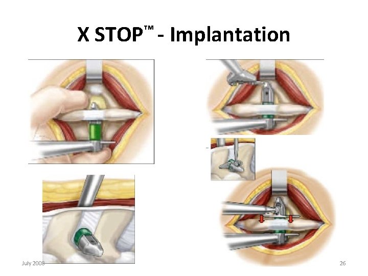 X STOP™ - Implantation July 2008 26 