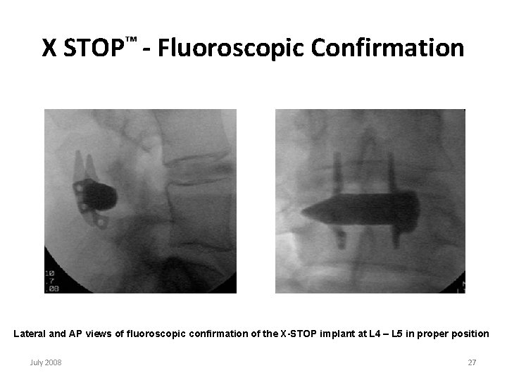 X STOP™ - Fluoroscopic Confirmation Lateral and AP views of fluoroscopic confirmation of the