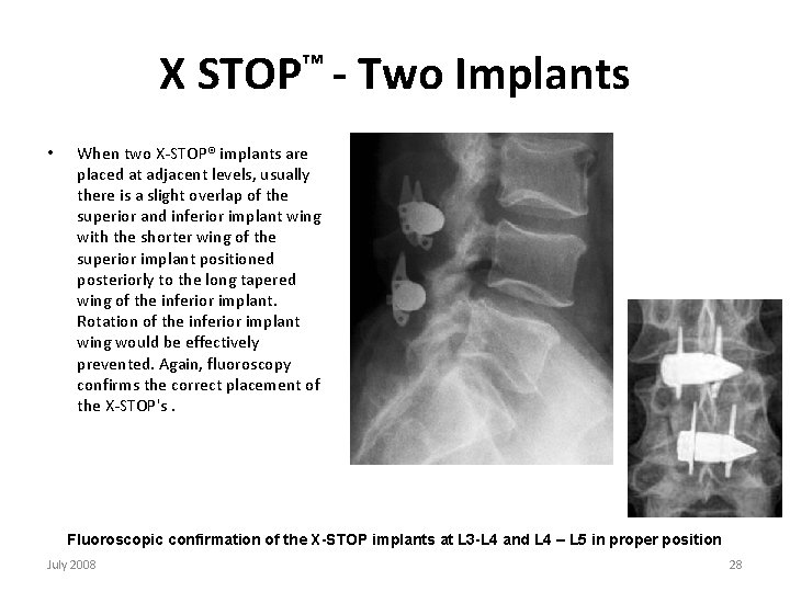 X STOP™ - Two Implants • When two X-STOP® implants are placed at adjacent