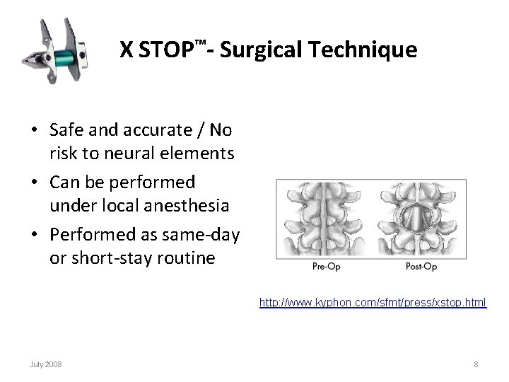  X STOP™- Surgical Technique • Safe and accurate / No risk to neural