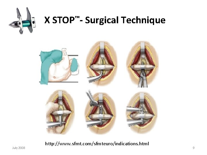  X STOP™- Surgical Technique July 2008 http: //www. sfmt. com/sfmteuro/indications. html 9 