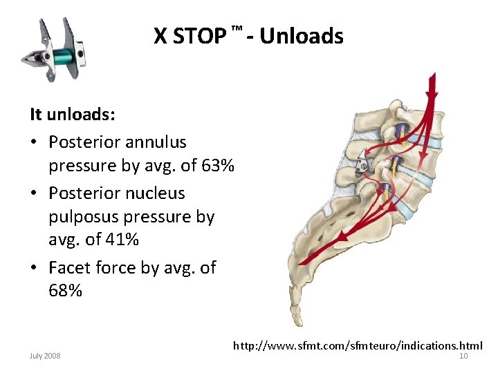 X STOP ™ - Unloads It unloads: • Posterior annulus pressure by avg. of