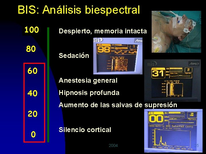 BIS: Análisis biespectral 100 80 Despierto, memoria intacta Sedación 60 Anestesia general 40 20
