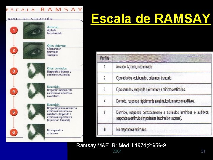 Escala de RAMSAY Ramsay MAE. Br Med J 1974; 2: 656 -9 2004 31