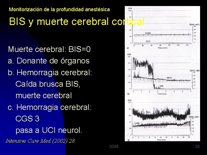 Monitorización de la profundidad anestésica BIS y muerte cerebral cortical Muerte cerebral: BIS=0 a.