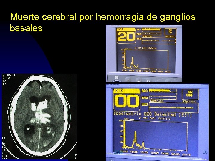 Muerte cerebral por hemorragia de ganglios basales 2004 36 