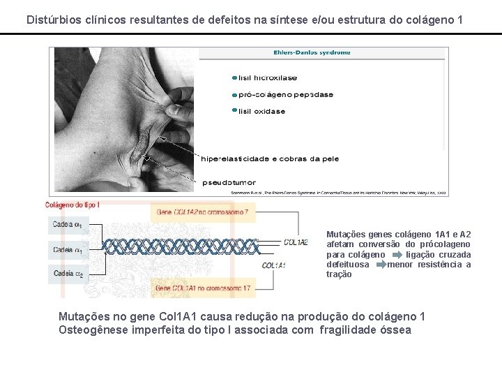 Distúrbios clínicos resultantes de defeitos na síntese e/ou estrutura do colágeno 1 Mutações genes