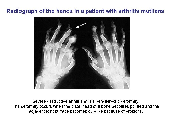 Radiograph of the hands in a patient with arthritis mutilans Severe destructive arthritis with