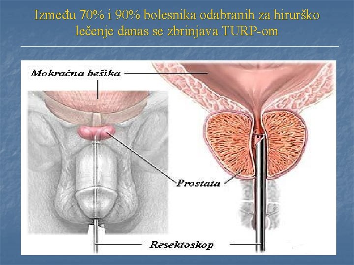 Između 70% i 90% bolesnika odabranih za hirurško lečenje danas se zbrinjava TURP-om Između 70% i 90% bolesnika odabranih za hirurško lečenje danas se zbrinjava TURP-om