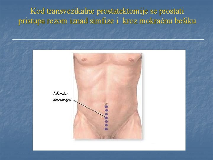 Kod transvezikalne prostatektomije se prostati pristupa rezom iznad simfize i kroz mokraćnu bešiku 