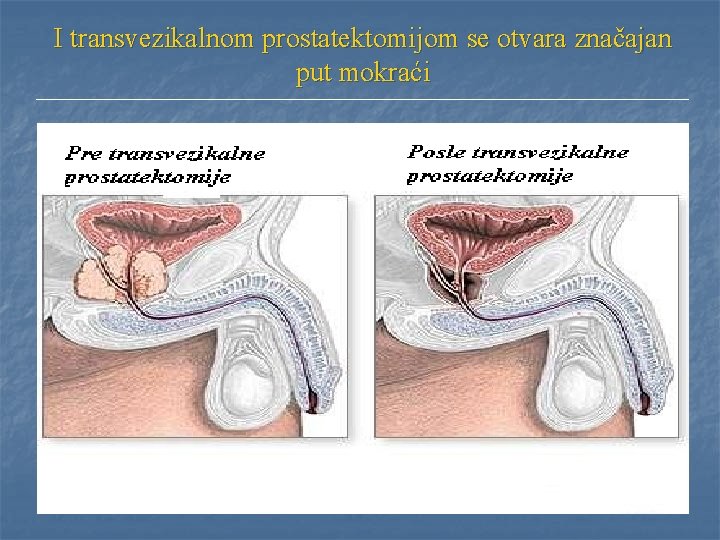 I transvezikalnom prostatektomijom se otvara značajan put mokraći I transvezikalnom prostatektomijom se otvara značajan put mokraći