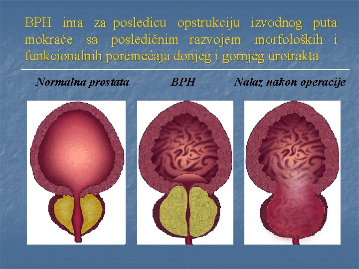 BPH ima za posledicu opstrukciju izvodnog puta mokraće sa posledičnim razvojem morfoloških i funkcionalnih