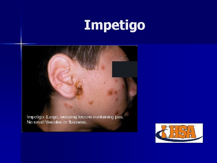 Impetigo 