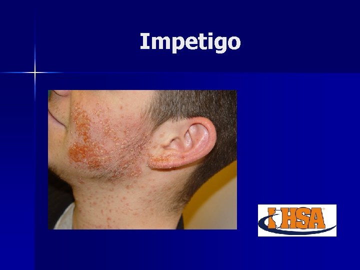Common skin conditions in wrestling Ringworm Impetigo Mulluscum