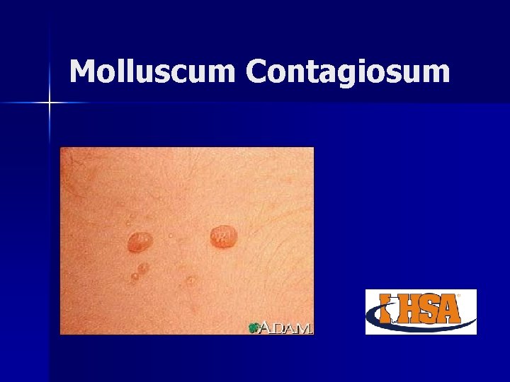 Molluscum Contagiosum 