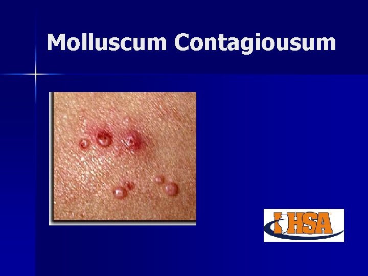 Molluscum Contagiousum 